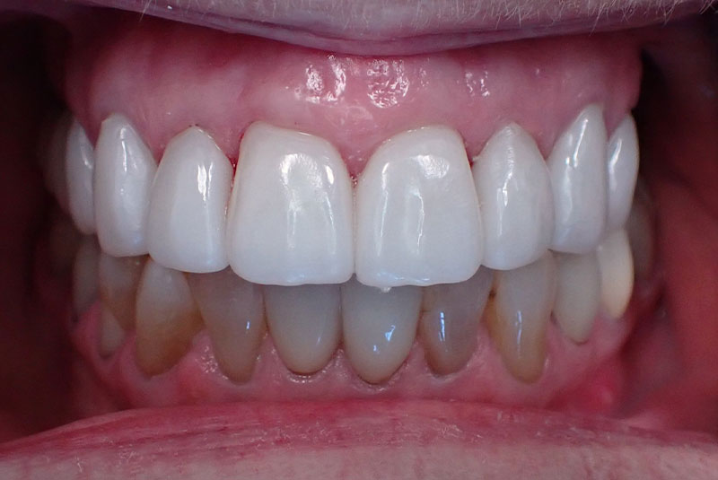 close up of before and after procedure