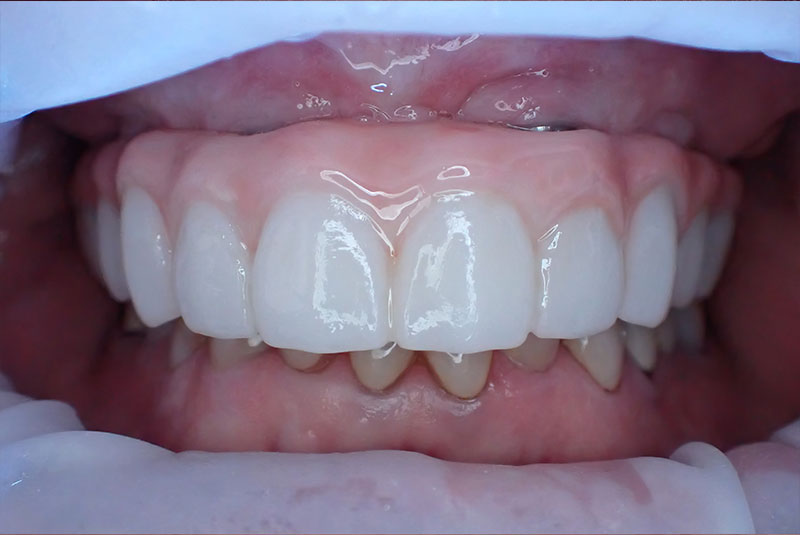 close up of before and after procedure