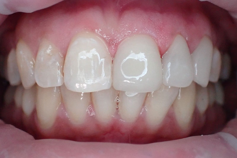 close up of before and after procedure