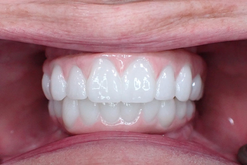 close up of before and after procedure