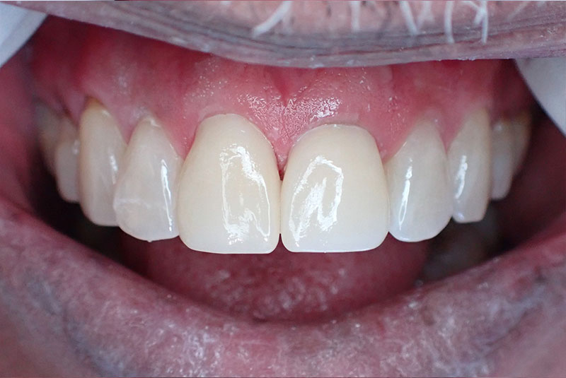 close up of before and after procedure