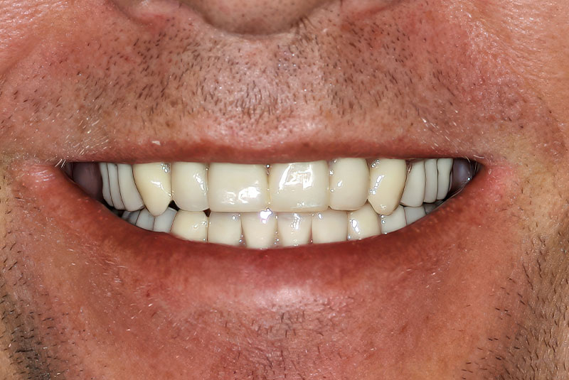 close up of before and after procedure