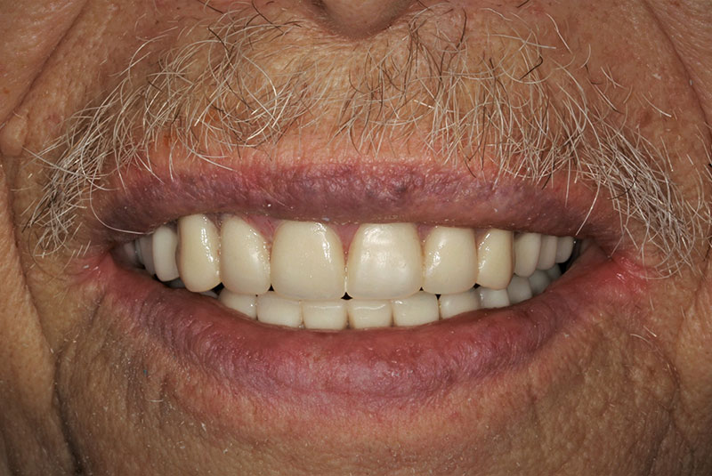 close up of before and after procedure