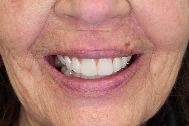 close up of before and after procedure