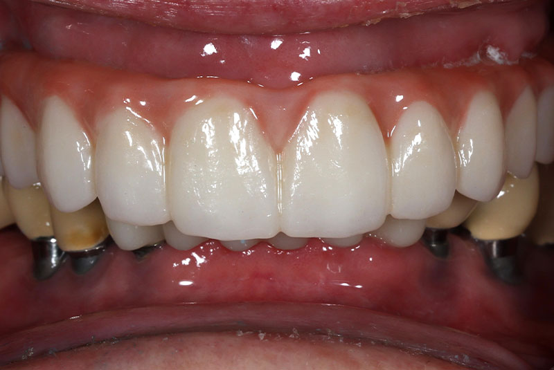 close up of before and after procedure
