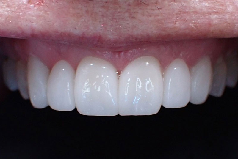 close up of before and after procedure