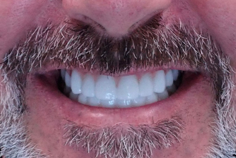 close up of before and after procedure