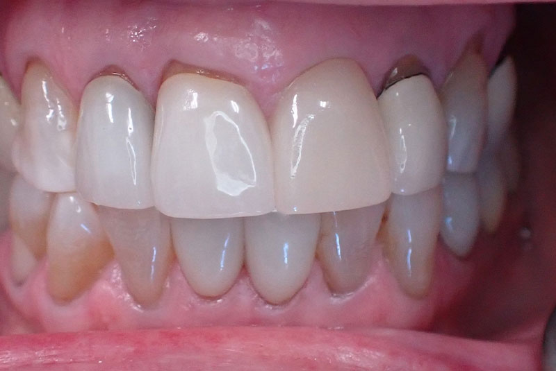 close up of before and after procedure