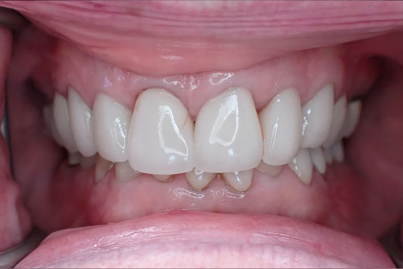 close up of before and after procedure