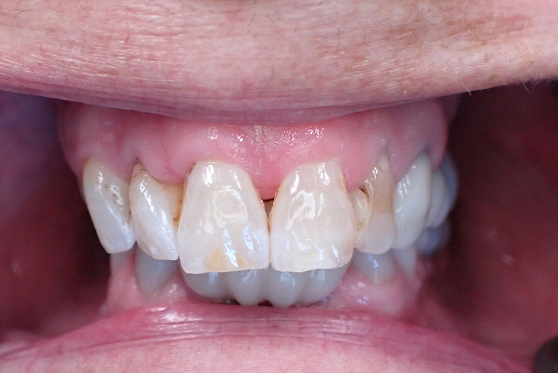 close up of before and after procedure