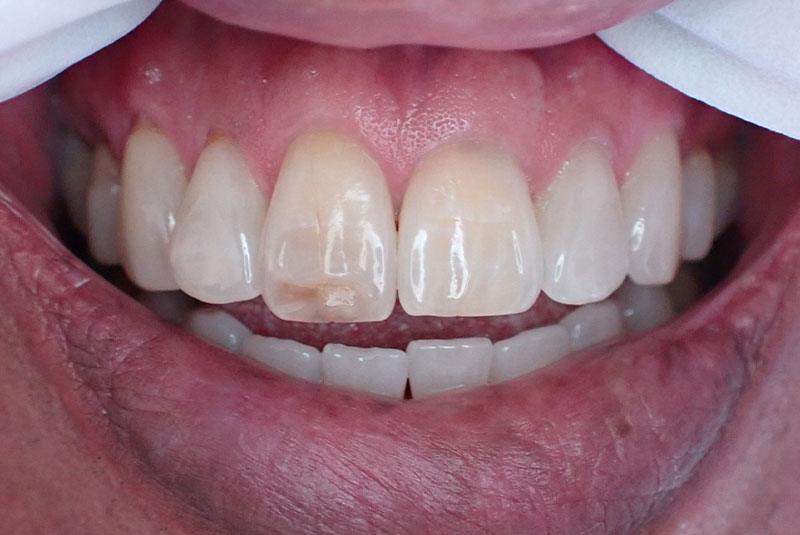 close up of before and after procedure