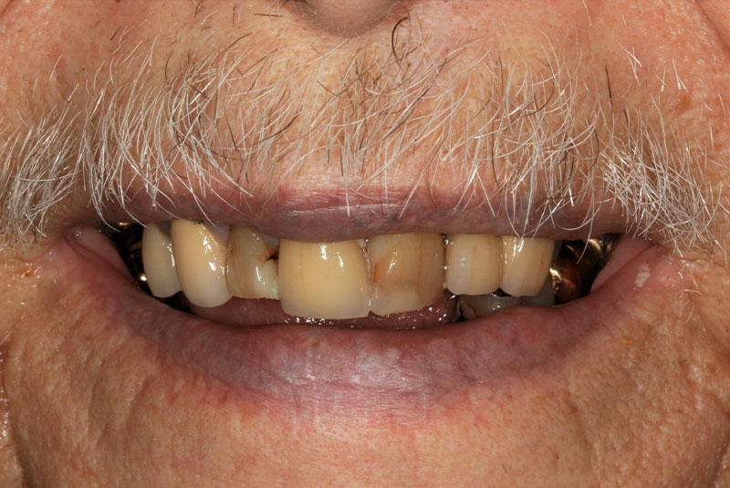 close up of before and after procedure