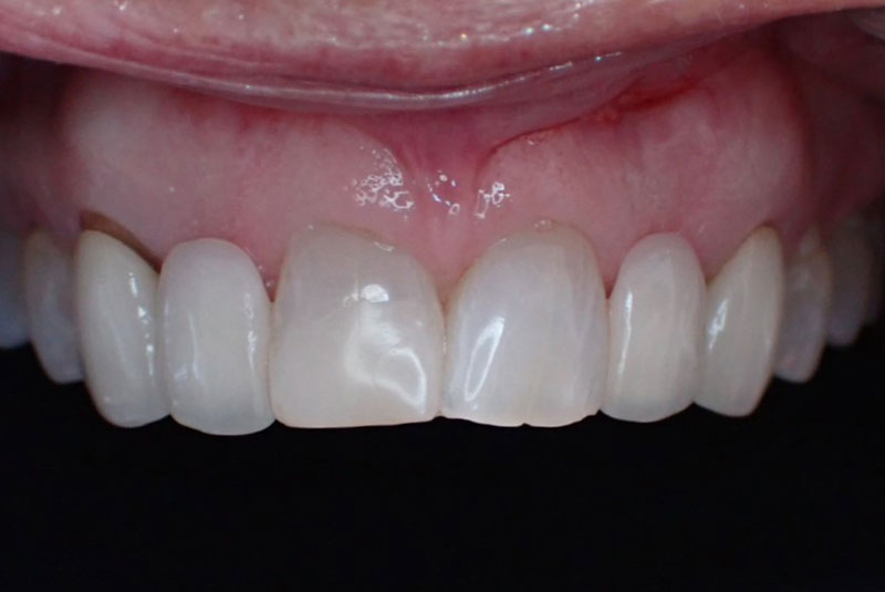 close up of before and after procedure