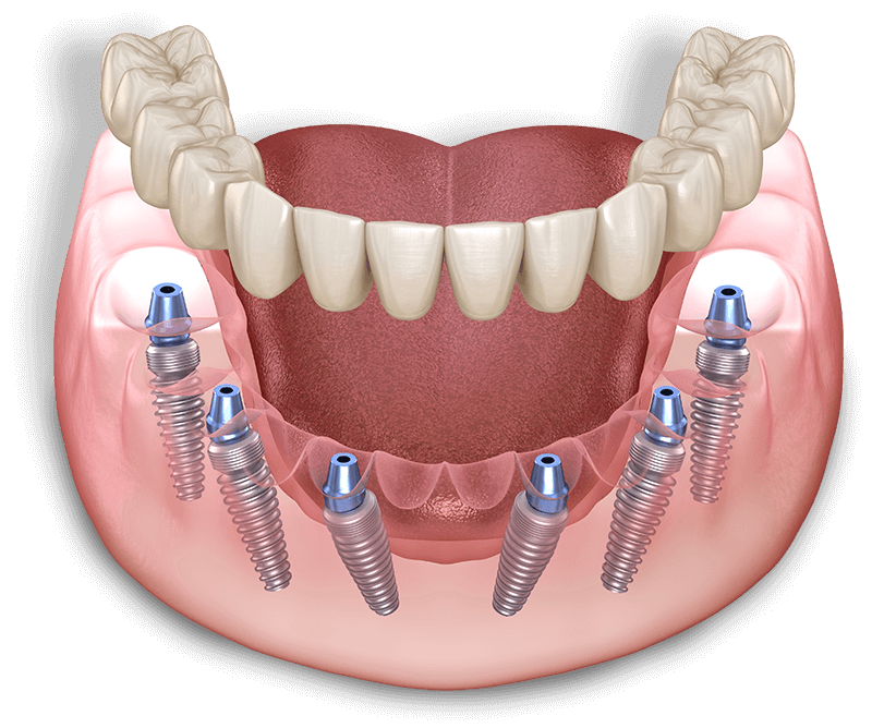 full arch dental illustration model