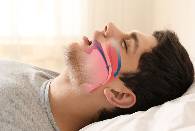 model explaining what sleep apnea is