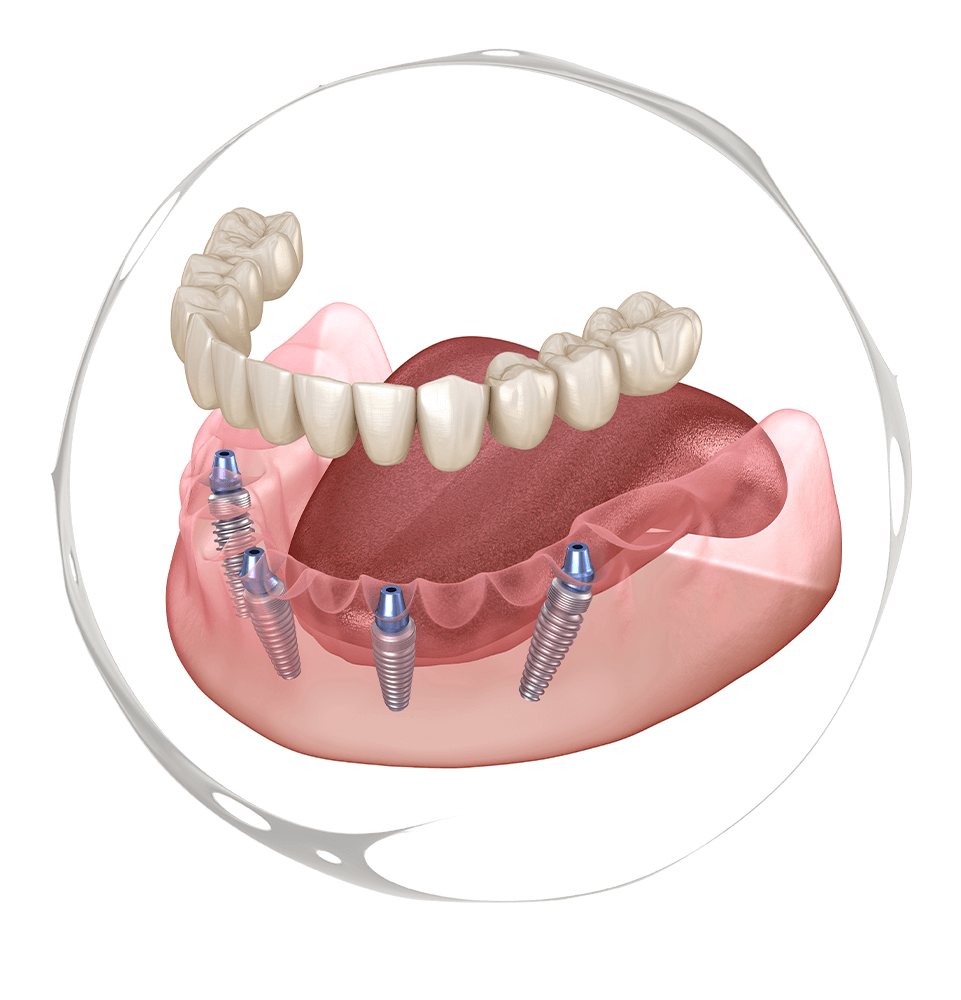 Full Arch Dental implants