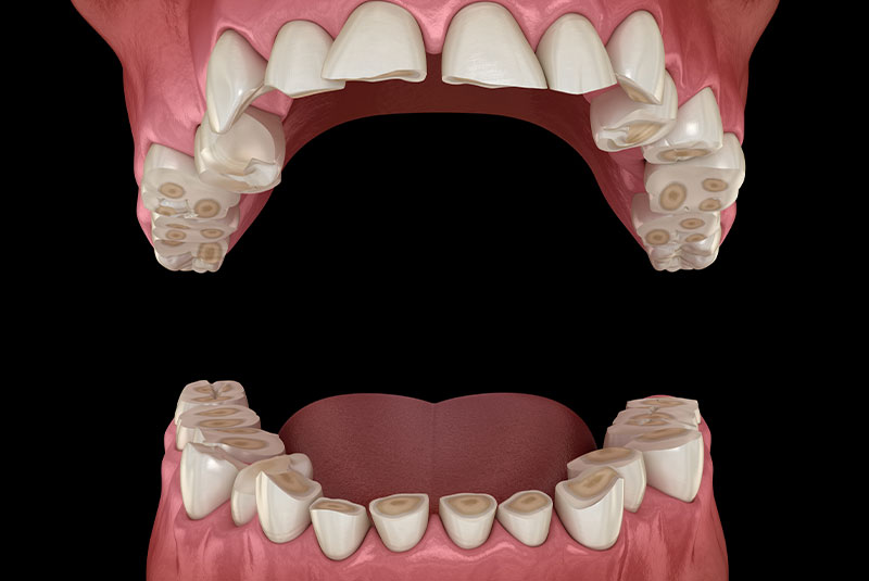 bruxism
