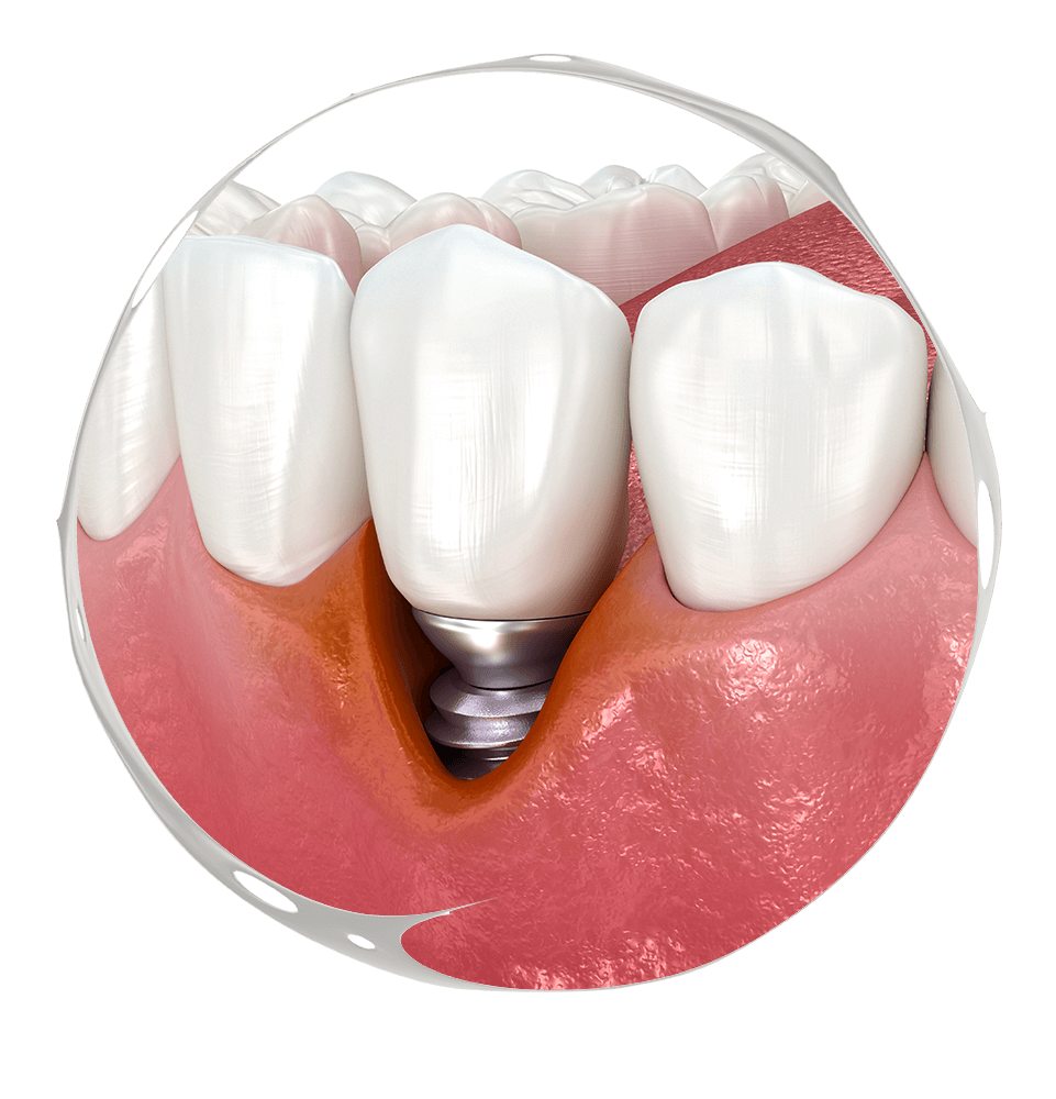 Failing dental implants