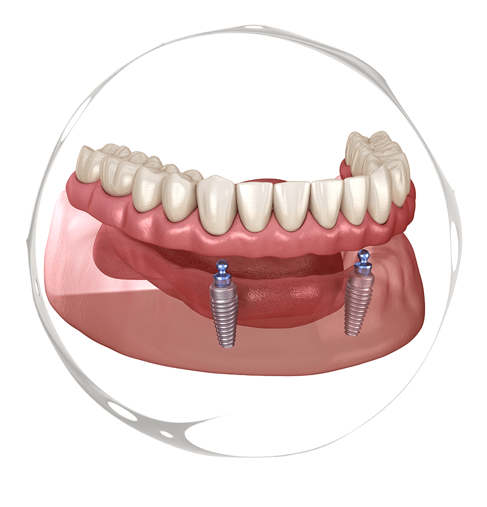implant supported dentures