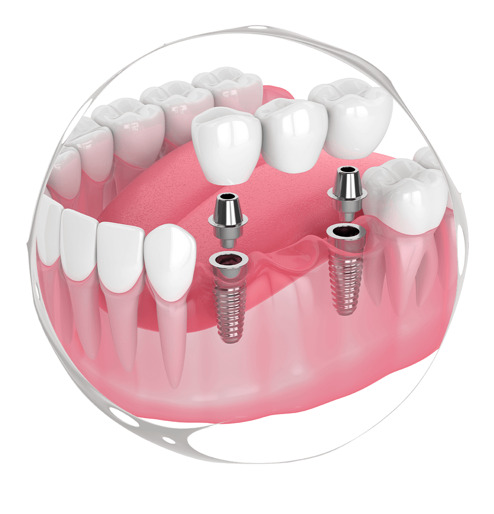 dental bridge