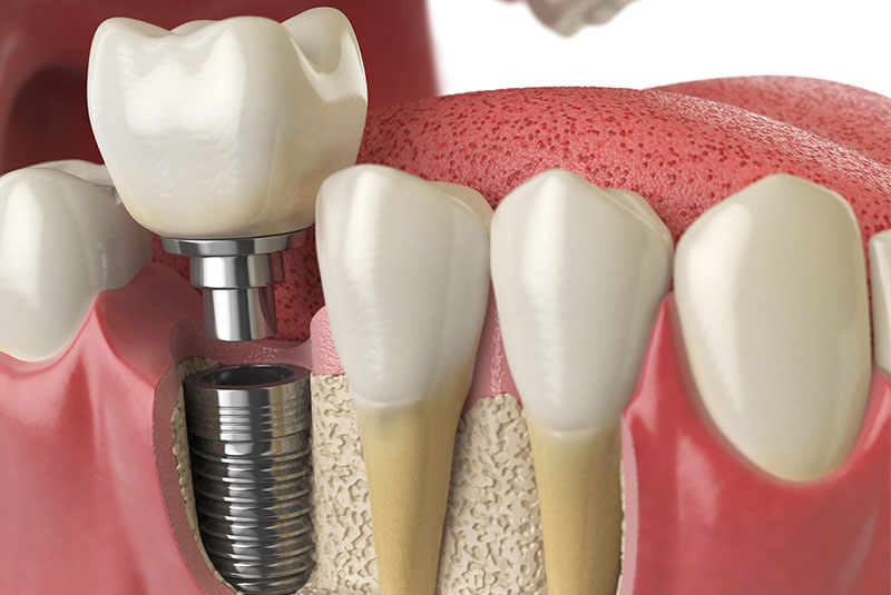 dental implant